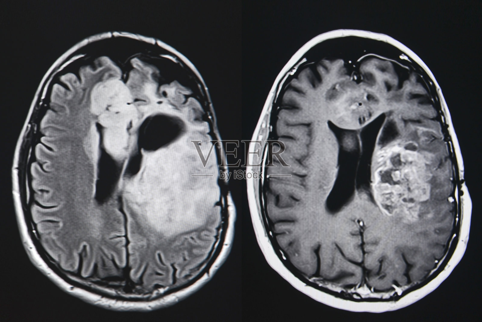 脑瘤,核磁共振照片摄影图片
