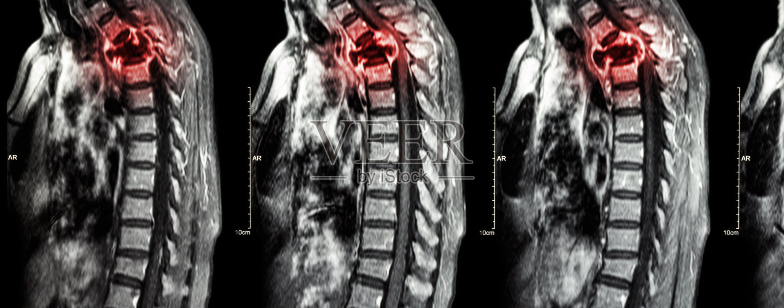 脊柱转移(癌症扩散至胸椎)照片摄影图片