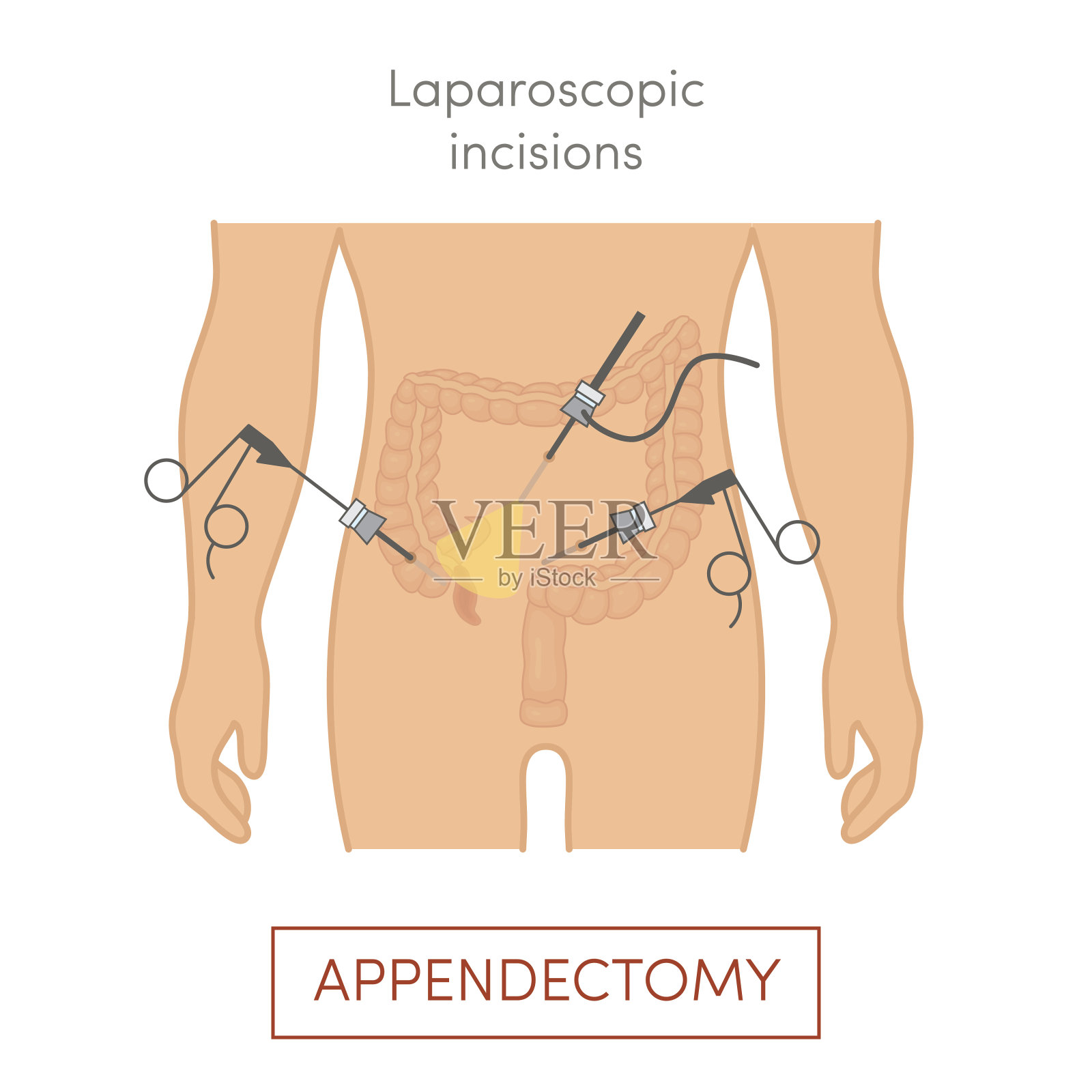 腹腔镜阑尾切除术-阑尾切除设计元素图片