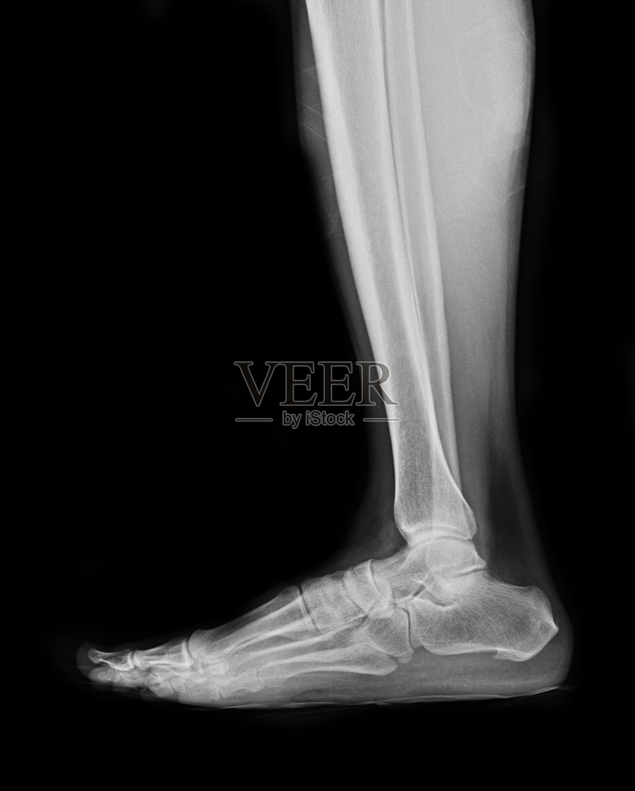 足部骨折患者的x线照片照片摄影图片