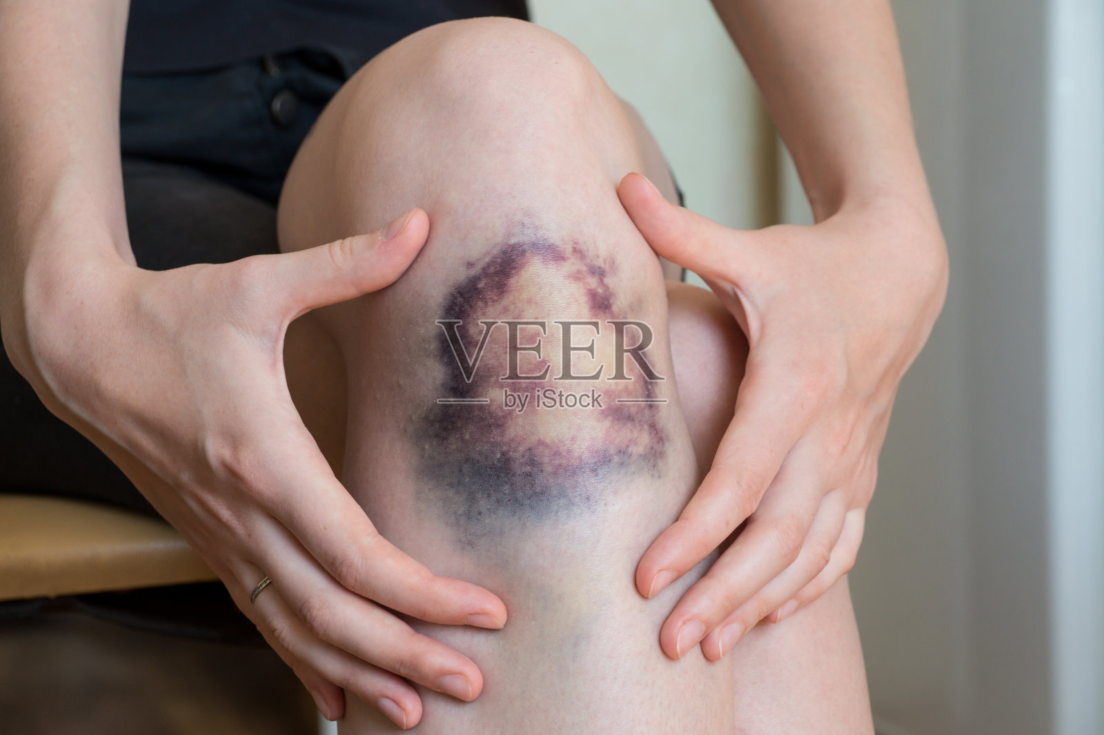 年轻女子的膝盖有大面积瘀伤照片摄影图片