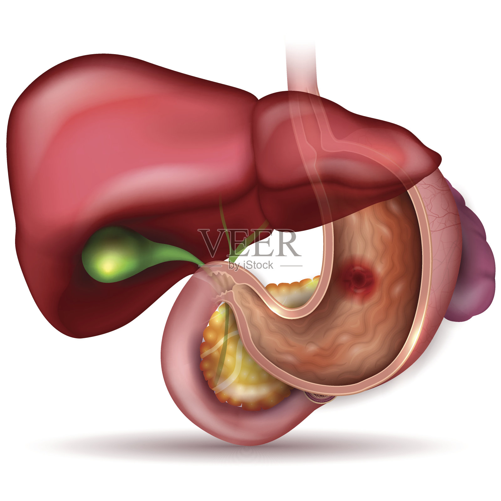 胃溃疡插画图片素材