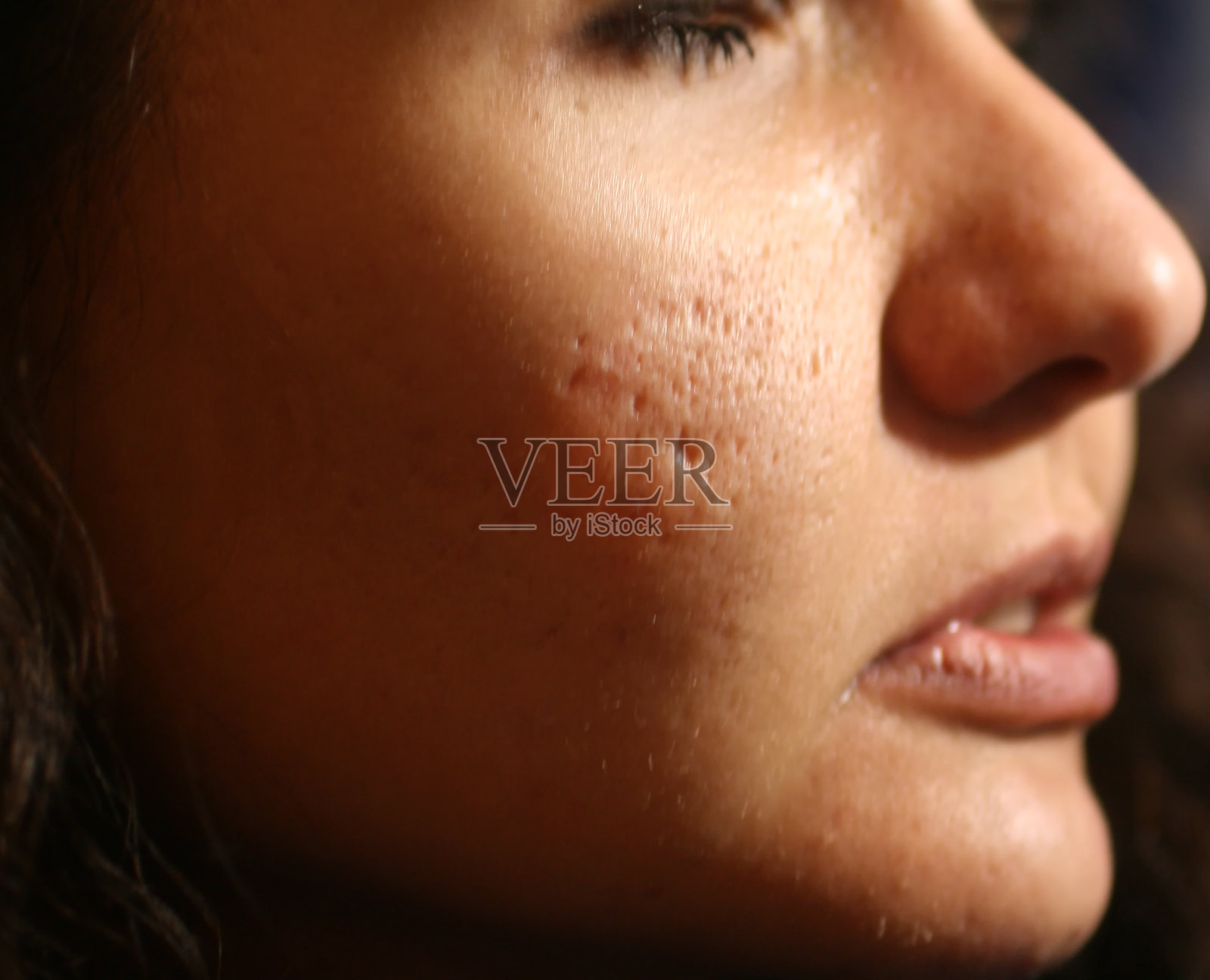 脸上有丘疹和痤疮的发炎皮肤。痤疮造成的疤痕照片摄影图片