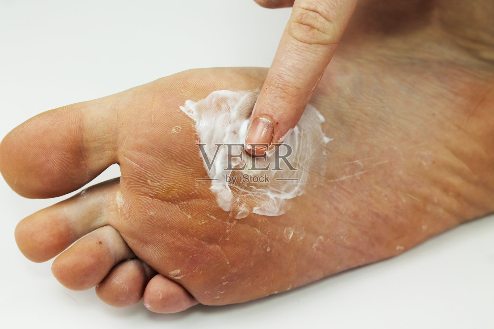 脚部真菌特写，孤立在白色背景上。皮肤科的概念，治疗真菌和真菌感染的人类。宏视频人的脚。给腿涂上抗真菌药膏照片摄影图片