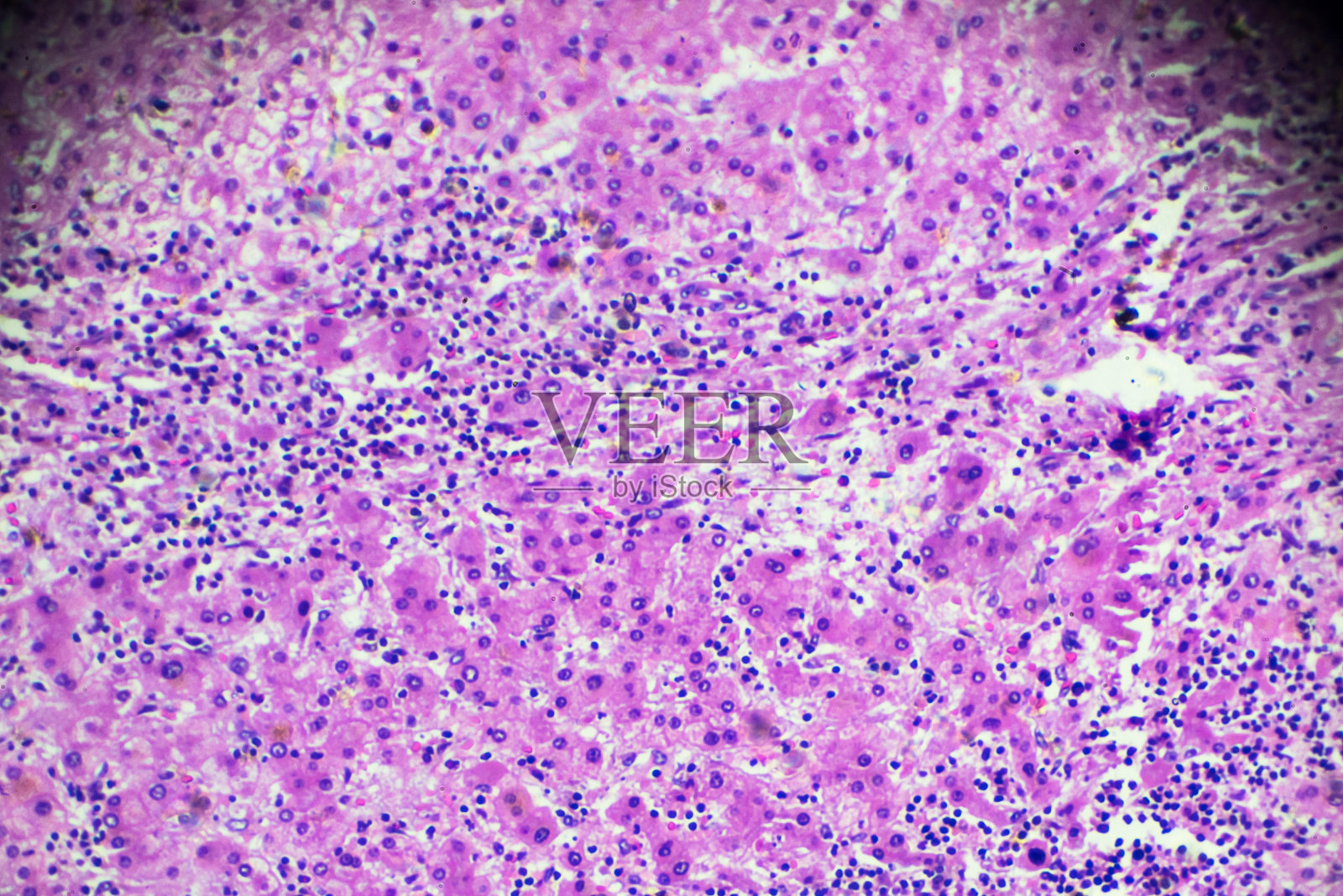 肝细胞癌，显微镜下的HCC照片摄影图片