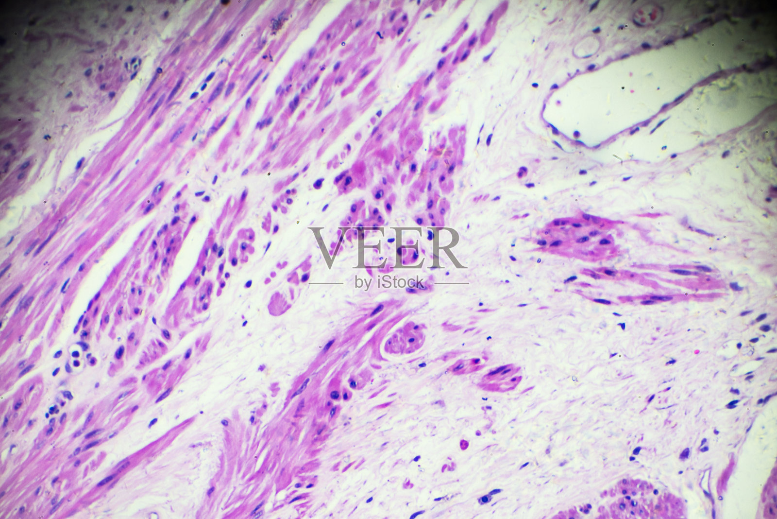 显微镜下前列腺癌活检照片摄影图片