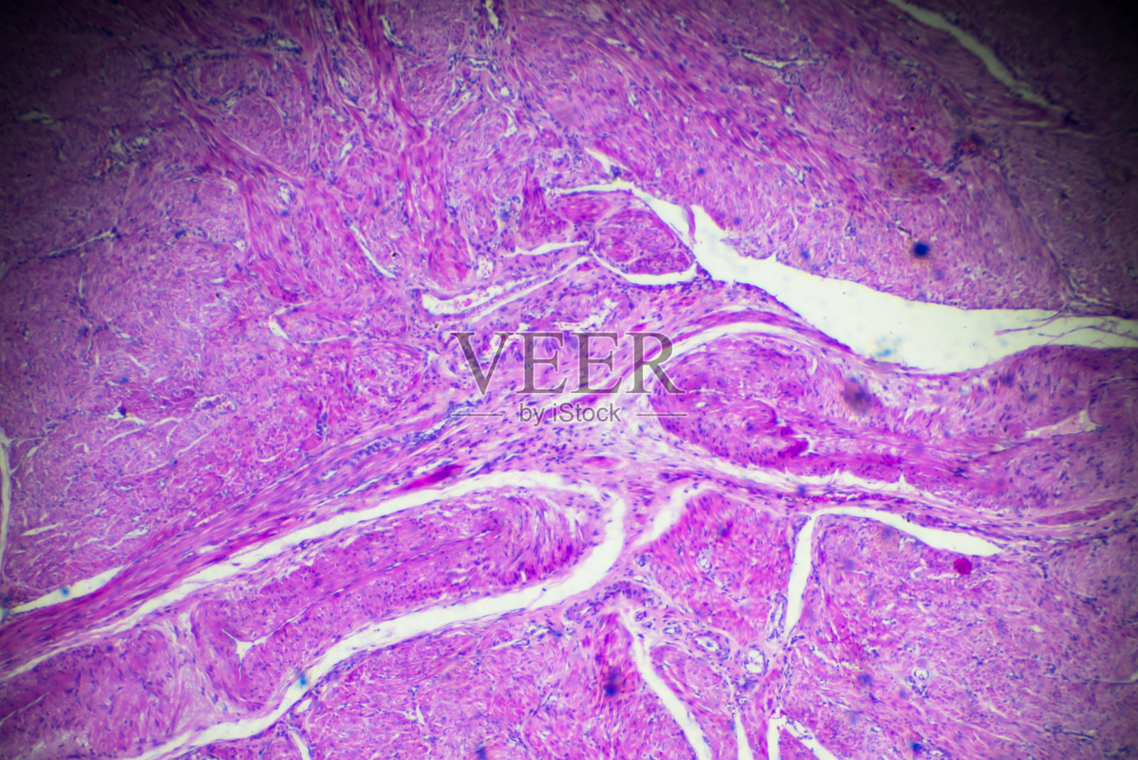 显微镜下子宫内膜癌生物样本照片摄影图片