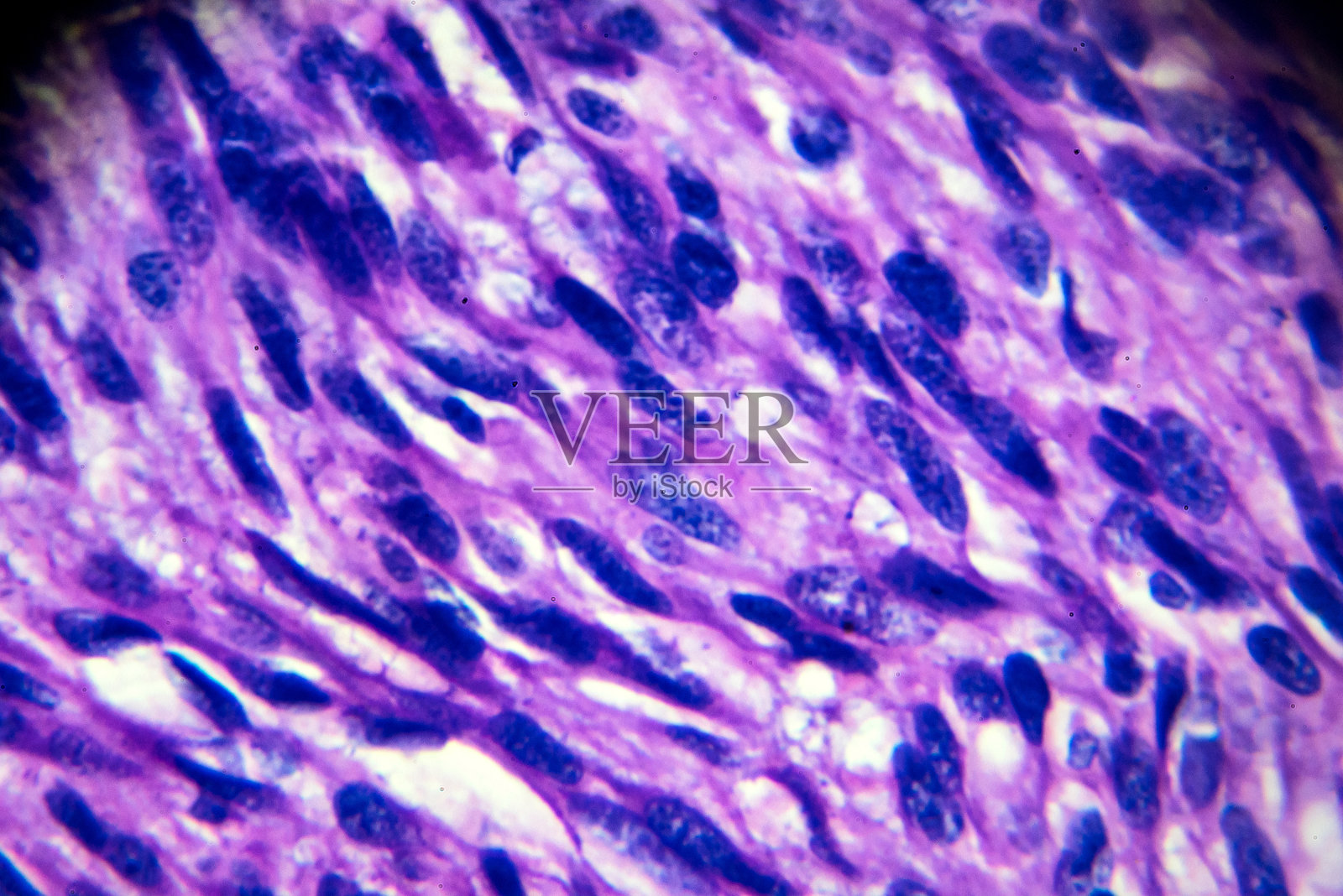 光镜下子宫平滑肌瘤活检标本照片摄影图片