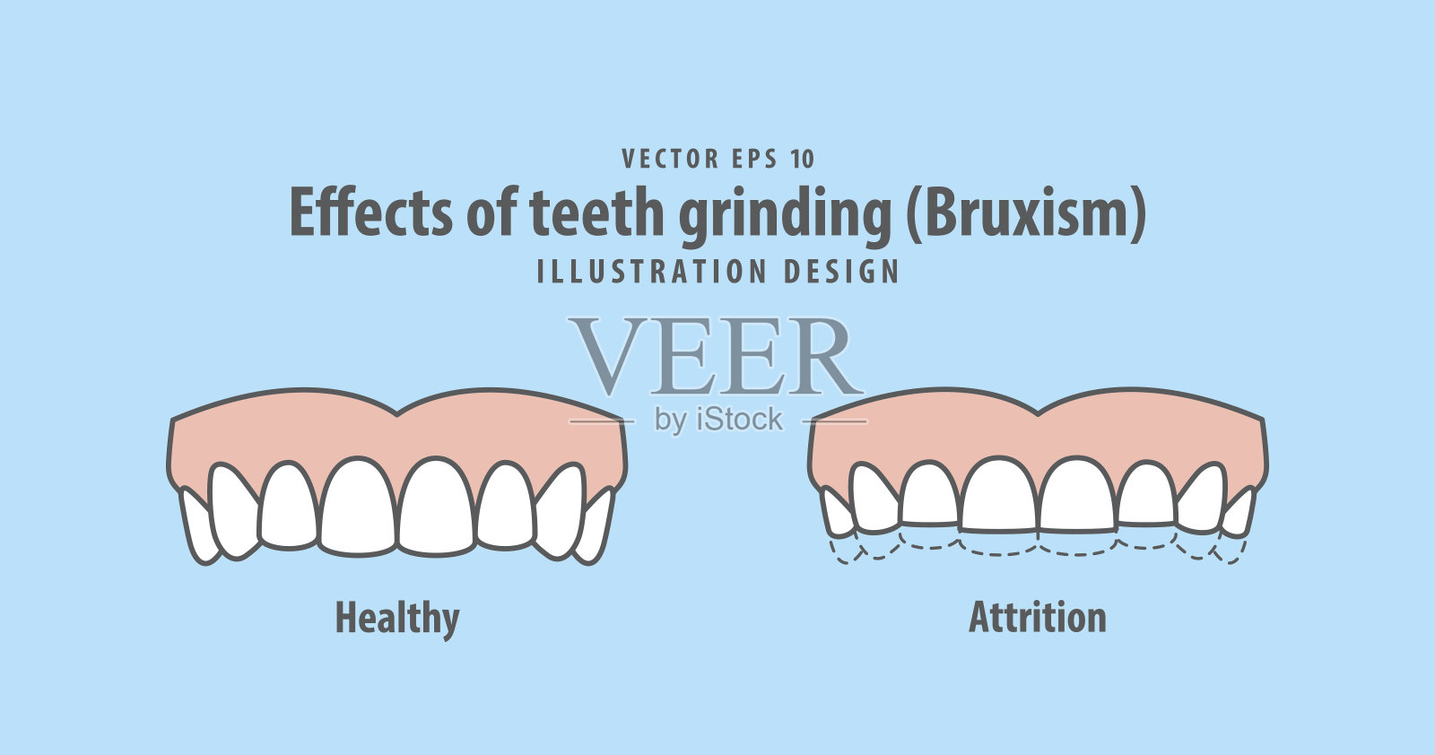 蓝色背景上磨牙(磨牙症)插图矢量的影响。牙科的概念。插画图片素材