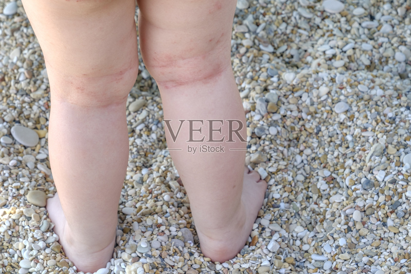 皮肤刺激新生儿腿部特应性皮炎照片摄影图片