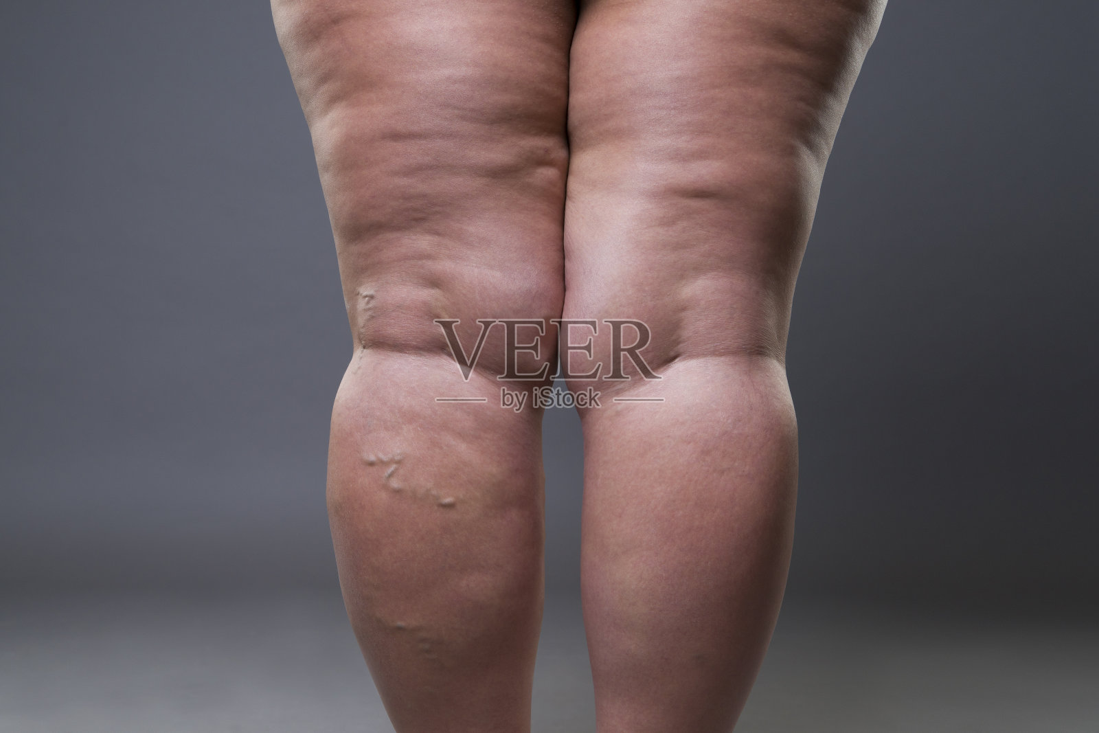 静脉曲张特写，女性腿部脂肪堆积照片摄影图片