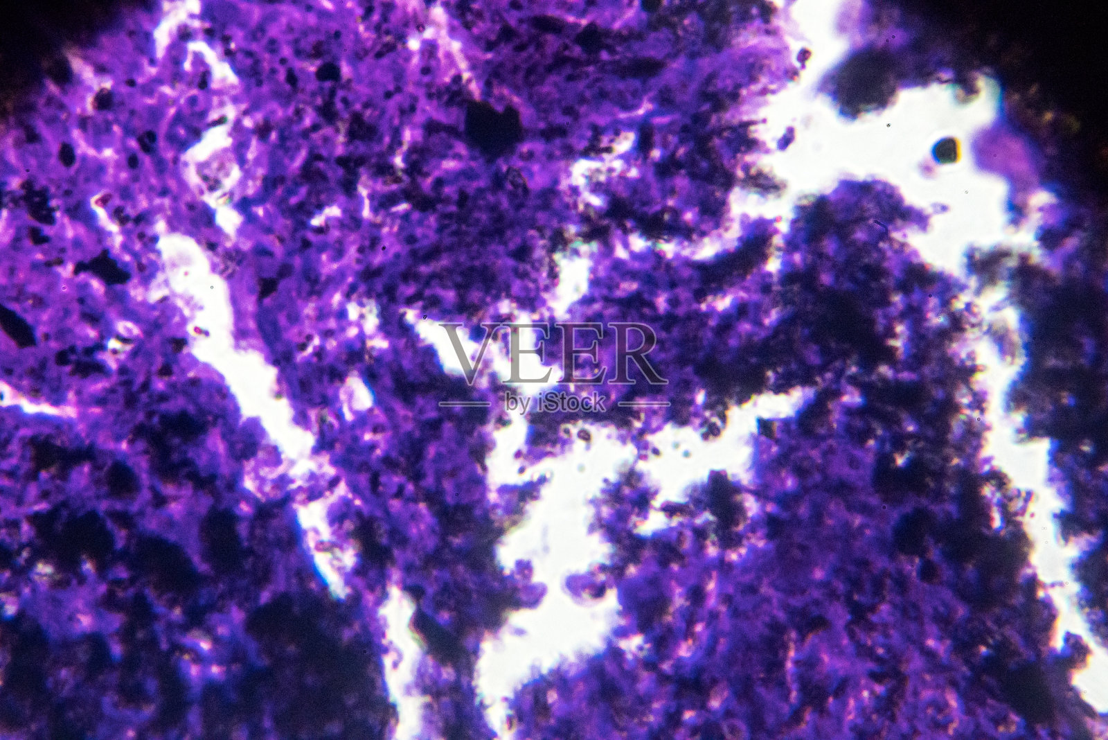矽肺伴有黑色沉积的人体病理生物样本照片摄影图片
