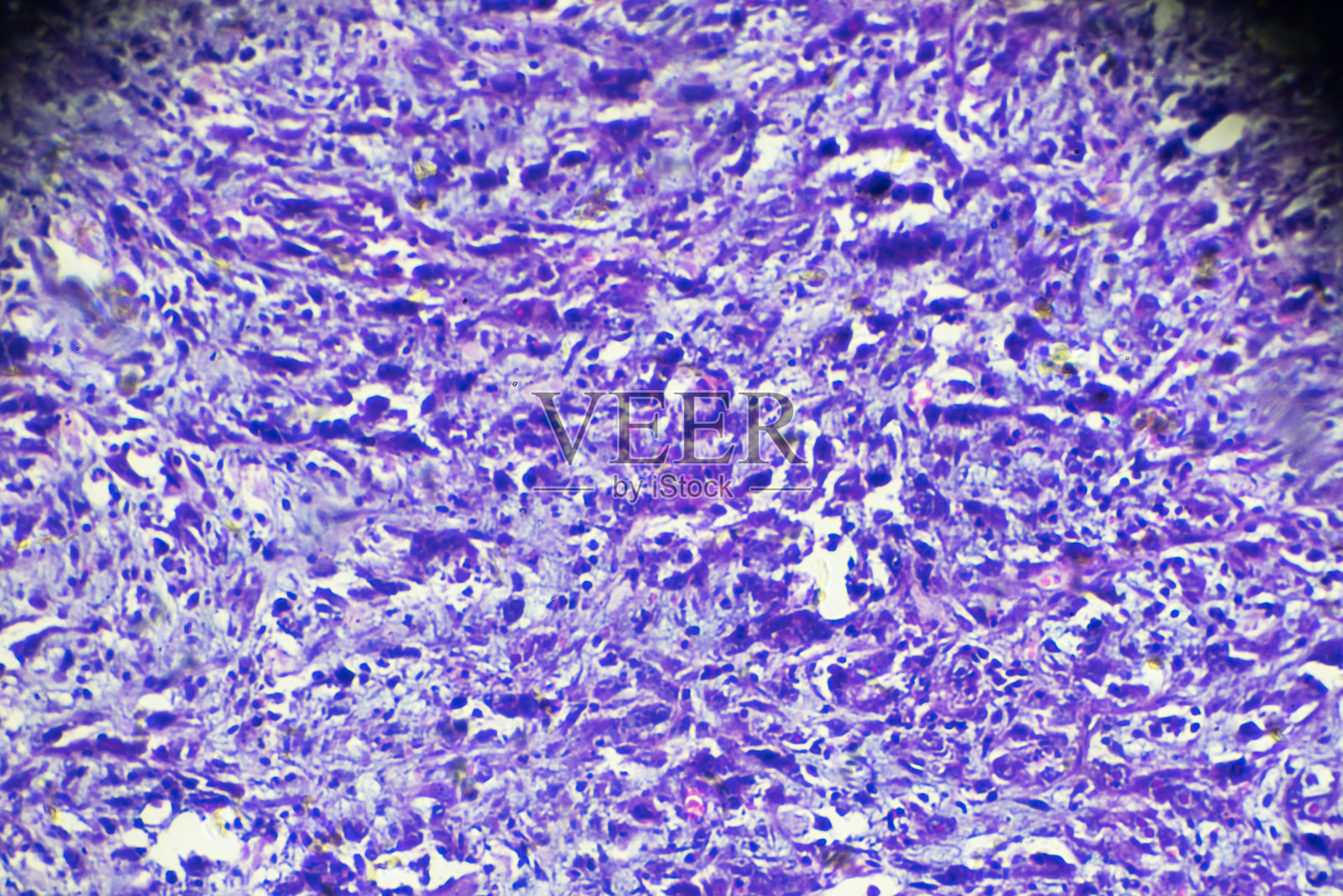 光镜下鼻咽癌(泡状核细胞癌)照片摄影图片