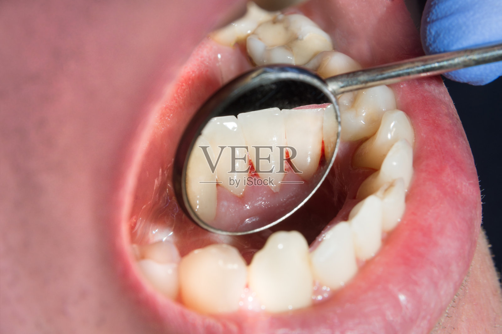 病人的斑块，结石。牙科治疗牙菌斑，专业口腔卫生。吸烟和清洁牙齿的危害概念照片摄影图片