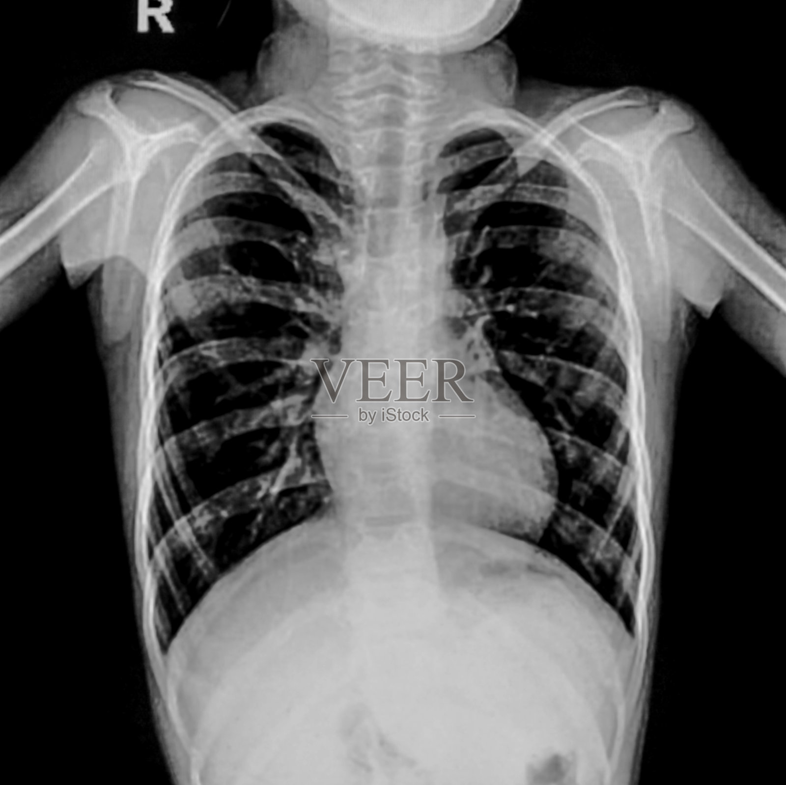 胸部x射线照片摄影图片