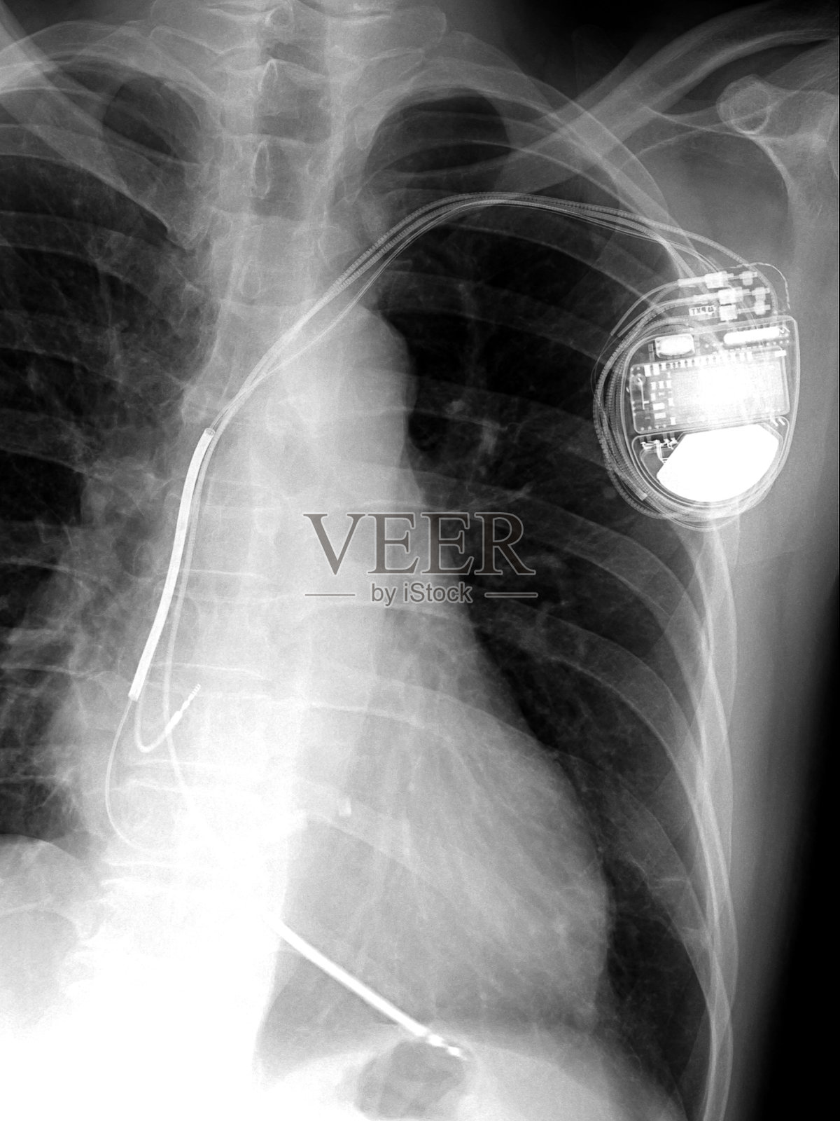 胸部植入永久性起搏器的x线影像照片摄影图片