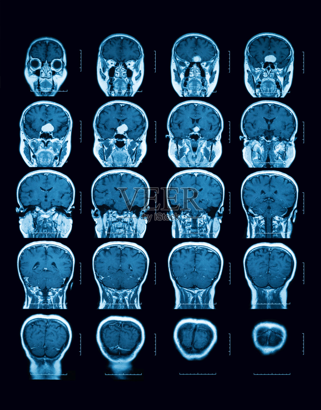 磁共振成像(MRI)扫描大脑，冠状视图。照片摄影图片