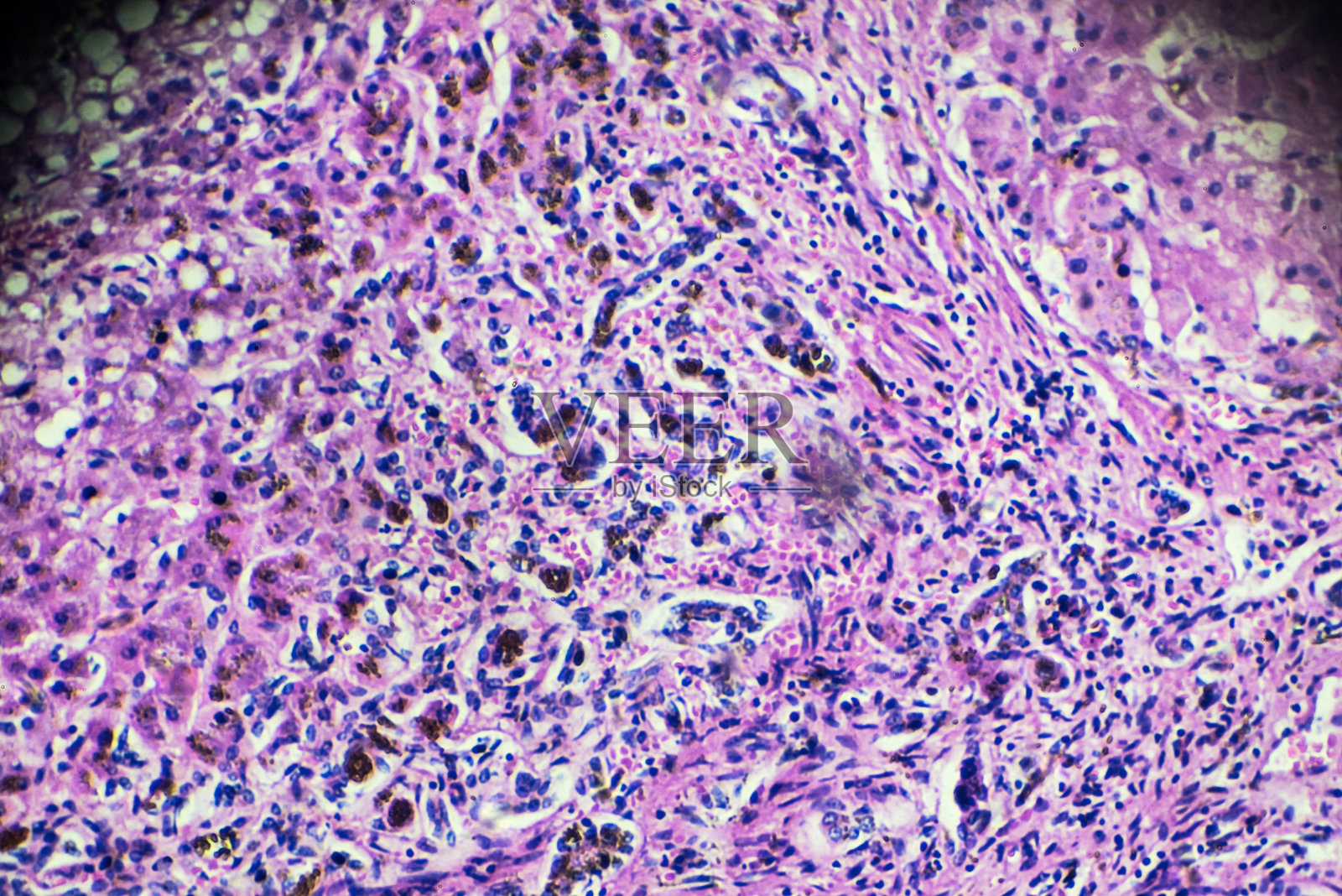 胆汁性肝硬化。显微镜下的人类病理标本照片摄影图片