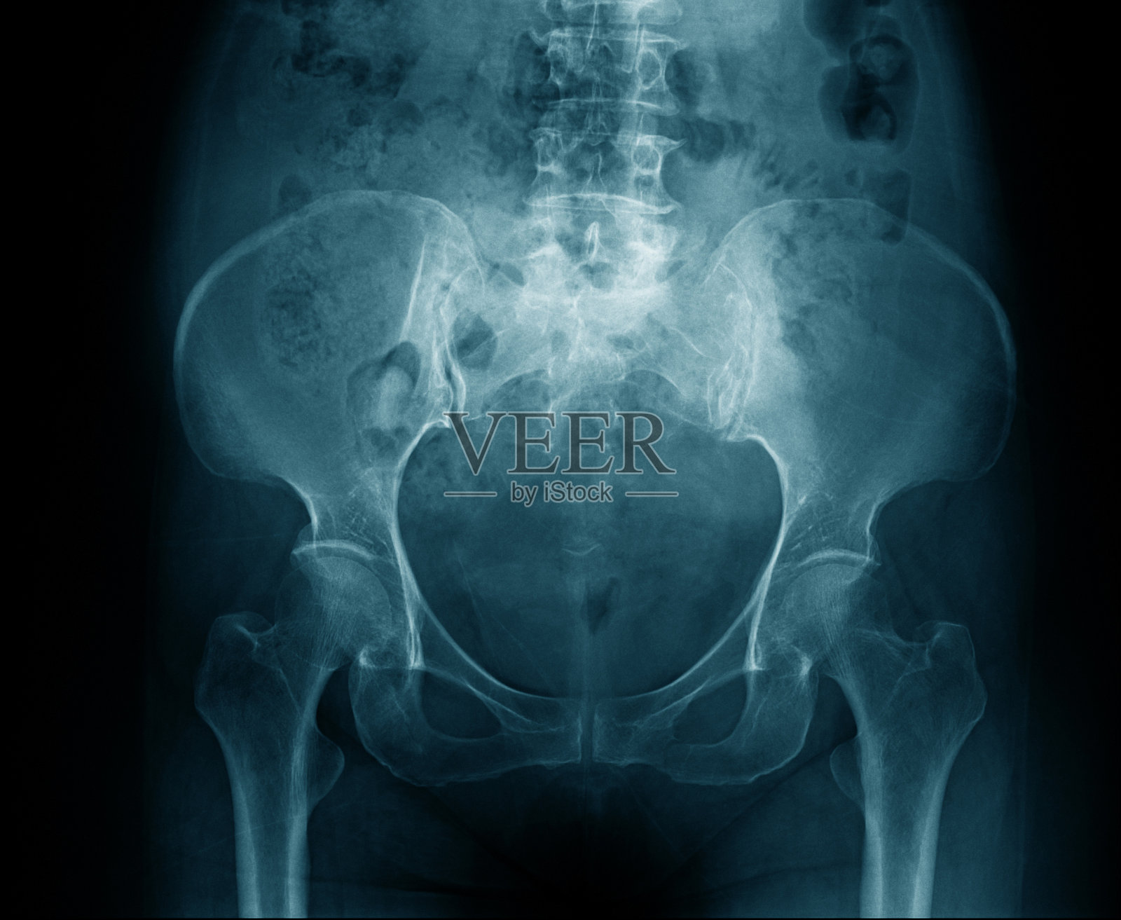 x线骨盆骨，高质量x线骨盆呈蓝色调照片摄影图片