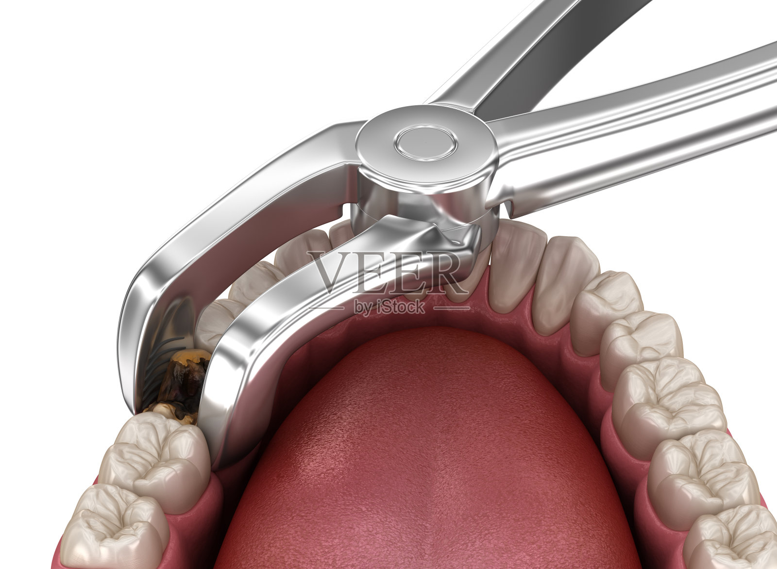 拔除受龋害的臼齿。医学上准确的牙齿3D插图。照片摄影图片