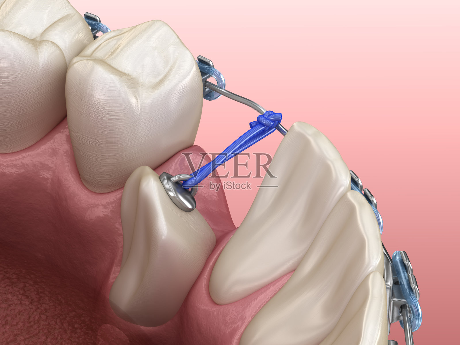 牙尖阻生，有弹性，可矫正。医学上准确的牙科3D插图照片摄影图片