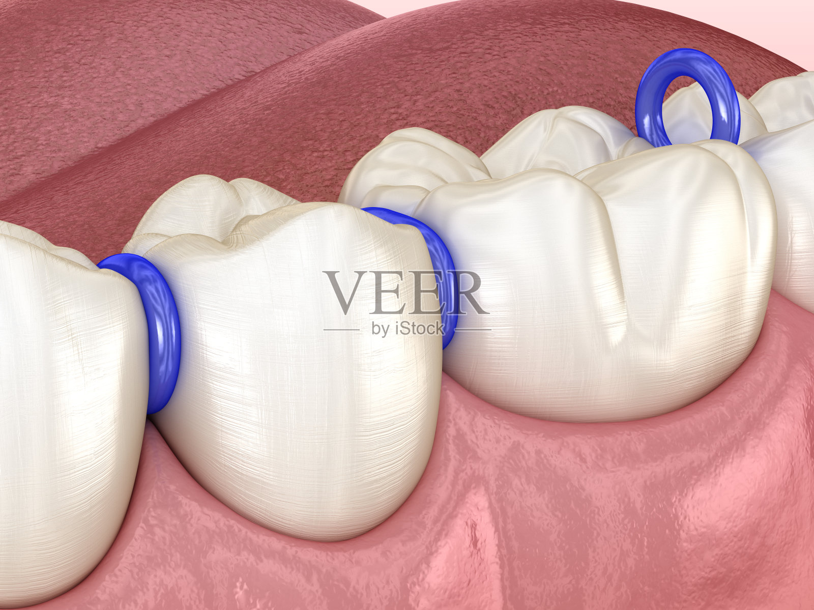 齿间橡胶分隔器，准备放置牙套。医学上准确的牙科3D插图照片摄影图片
