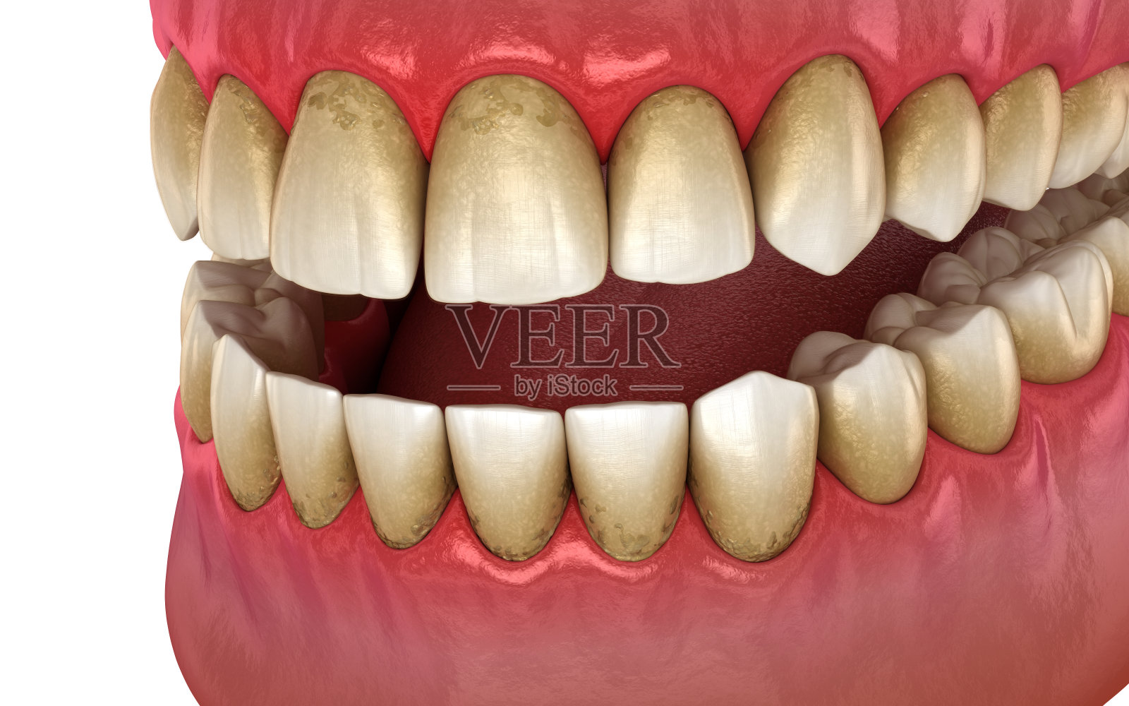 牙垢和牙菌斑，下巴发炎。医学上精确的人类牙齿治疗的3D插图照片摄影图片