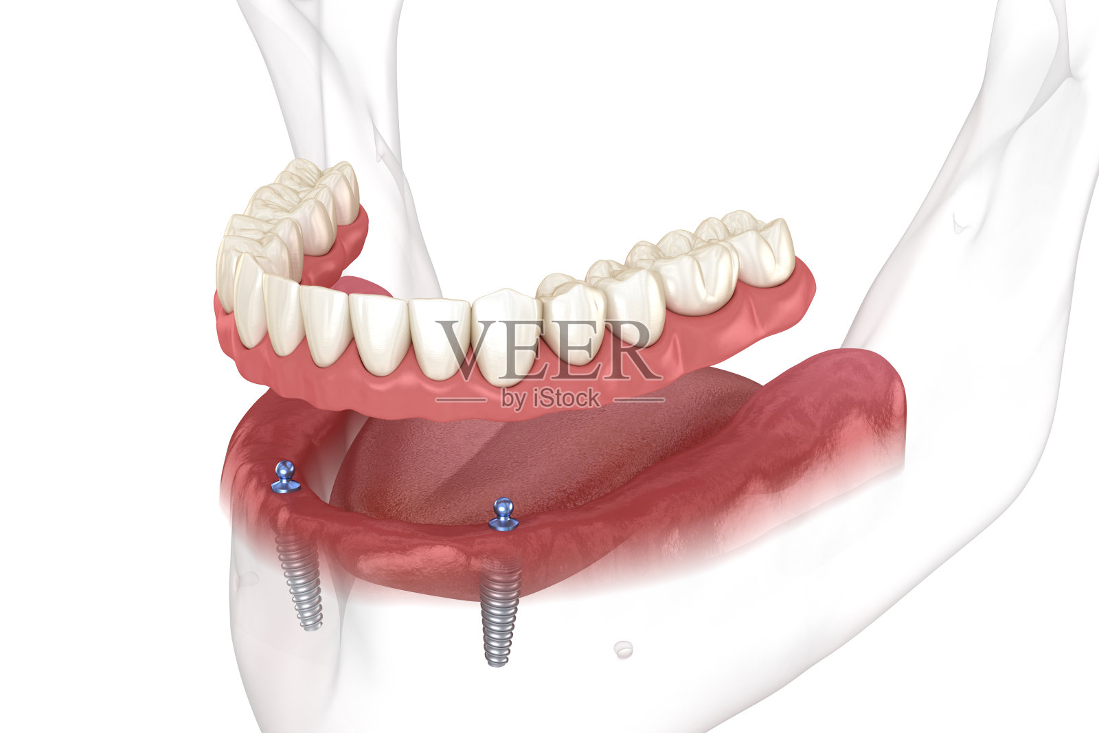 下颌可移动假体全部在2个系统支持种植体与球附件。医学上准确的牙科3D插图照片摄影图片